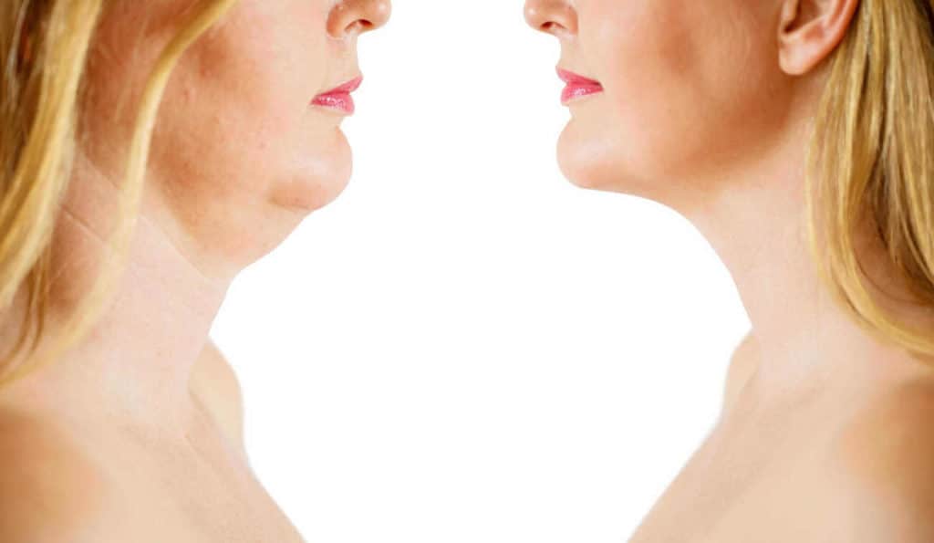 Double Chin treatment Kingston Hill before and after results