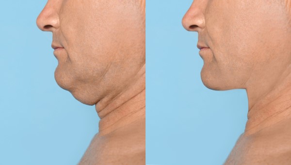 Which Non-Surgical Treatments Work Best for Jowls and Loose Skin Kingston Hill?