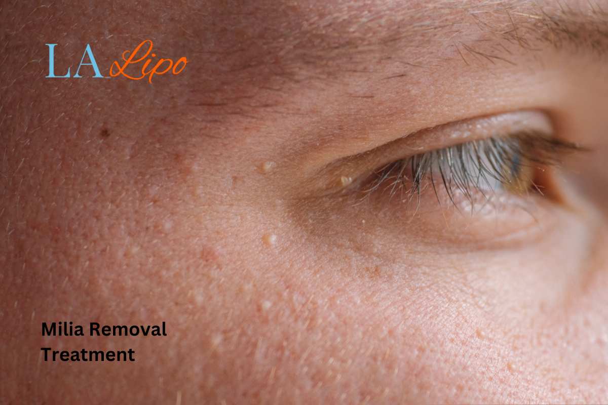 Cryopen Milia Removal: Is It the Easiest and Safest Option Kingston Hill?