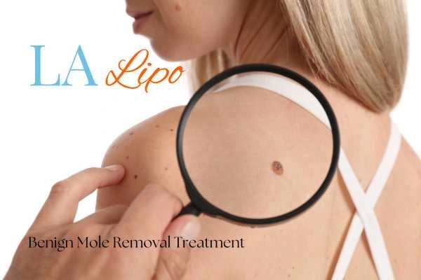 Why getting moles removed Kingston Hill can boost your confidence!
