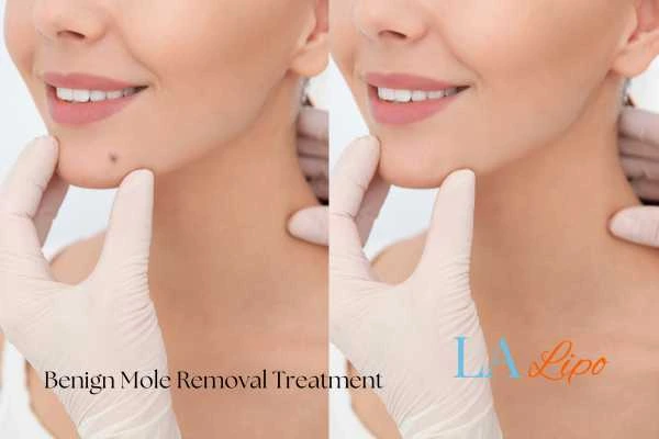 Woman's before and after results of being moles removal treatment Kingston Hill