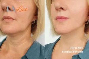 hi-fu for wrinkles Kingston Hill before and after results