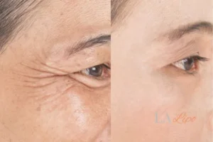 Before and after results of woman - HI-fu wrinkles reduction treatment Kingston Hill