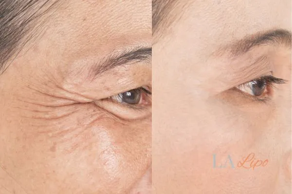 Before and after results of woman - HI-fu wrinkles reduction treatment Kingston Hill