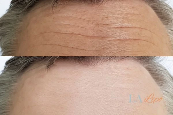 results of HIFU Kingston Hill on mans forehead to help reduce lines and wrinkles
