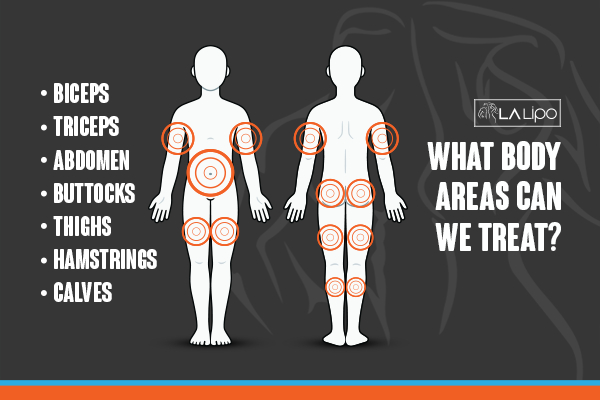 Graphic to show areas you can have LA-EMS Body Sculpting Kingston Hill treatment.