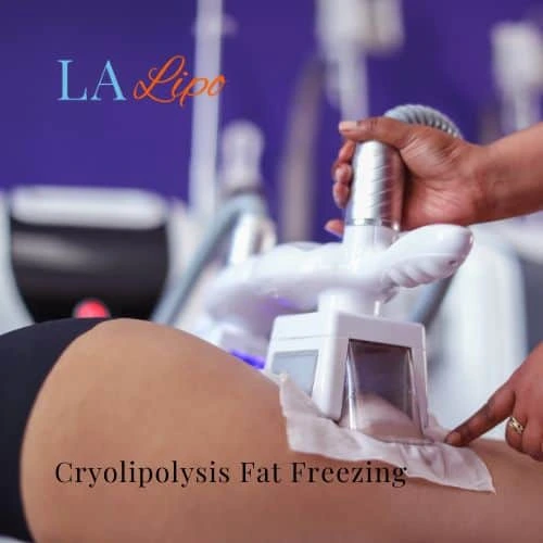 fat freezing - Cryolipolysis Kingston Hill