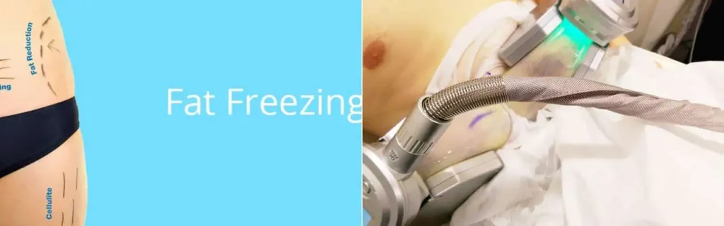 Fat freezing Kingston Hill on multiple areas of the body