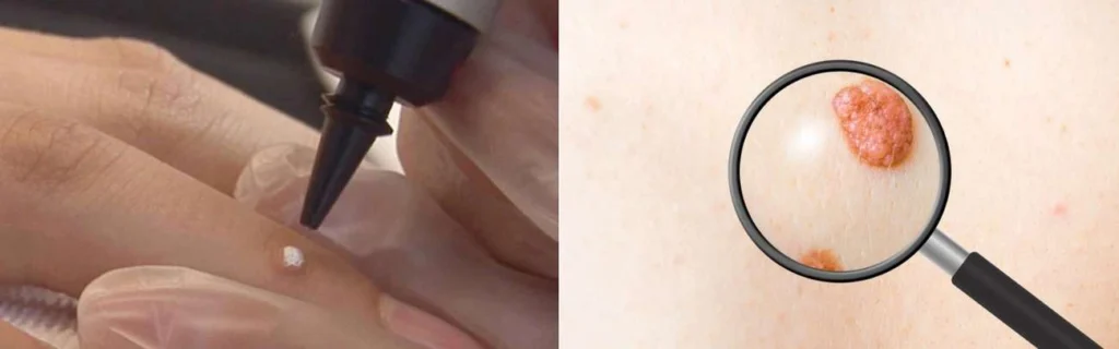 Person getting moles removed with cryopen Kingston Hill