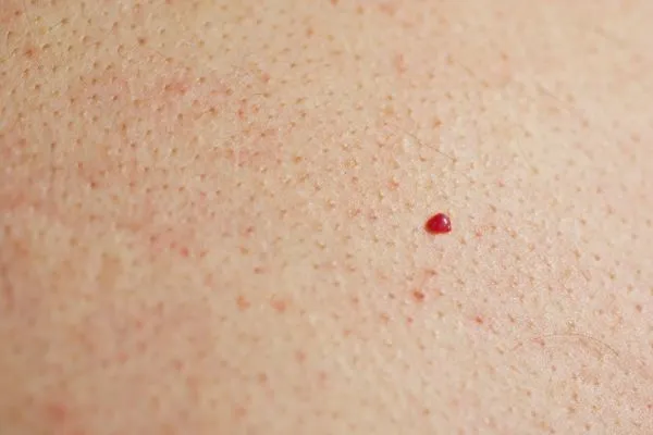 close up of a cherry angioma Kingston Hill