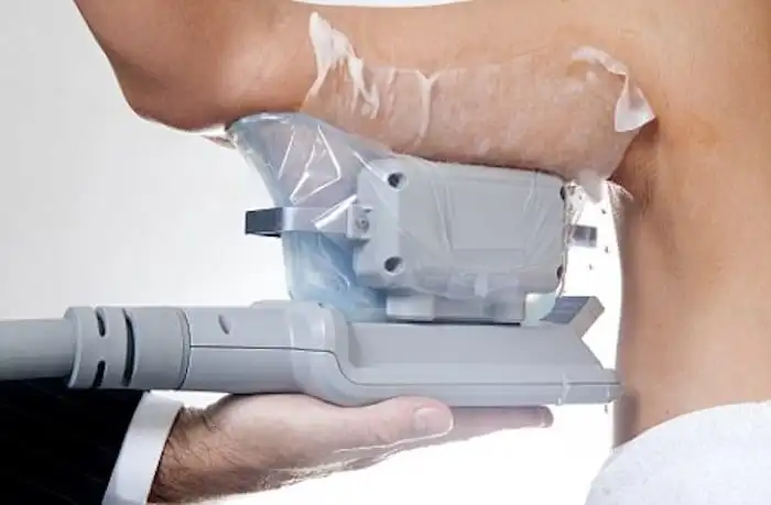 Picture of fat freezing Kingston Hill on the upper arms.