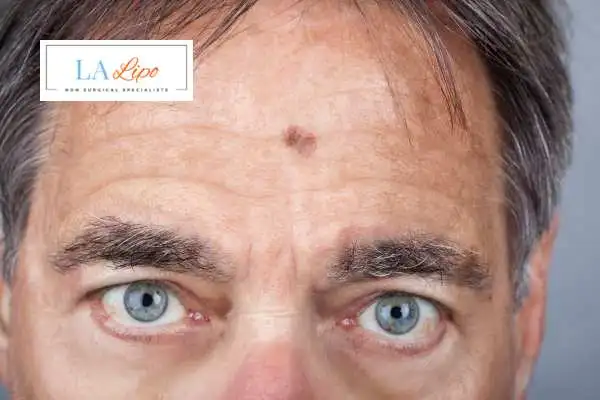Solar Lentigo Removal Kingston Hill image of man with mark on his forehead