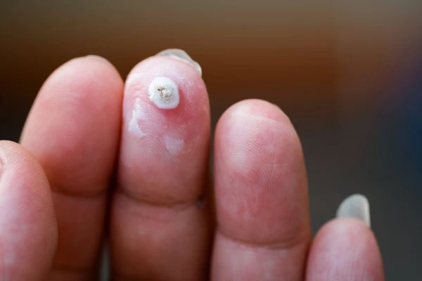 wart on person finger - cryotherapy to treat from LA LIPO Kingston Hill