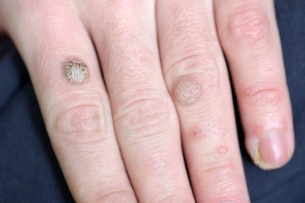 photo of warts on person hand - see wart removal Kingston Hill from LA LIPO