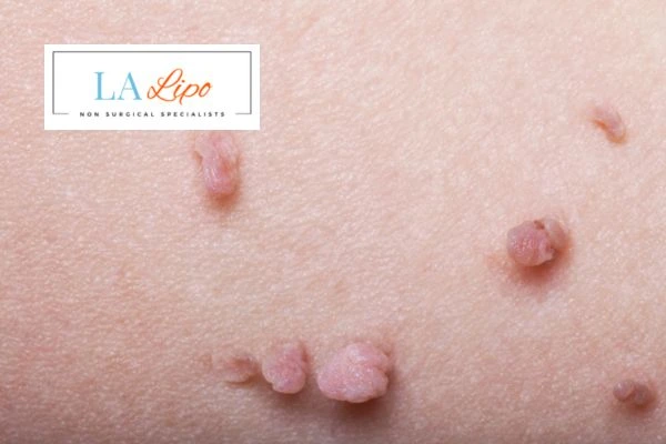 Does cryopen skin tag removal Kingston Hill hurt? Find out now call our team today!
