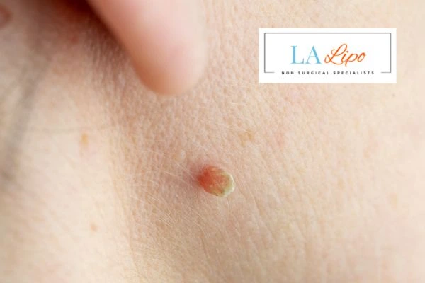 Book skin tag removal Kingston Hill today speak to our team now!