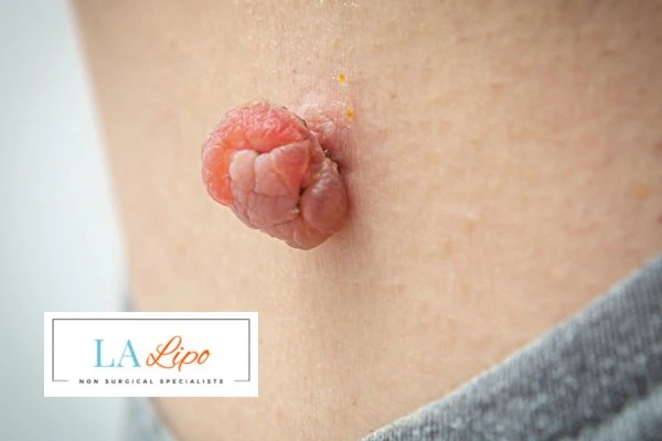 Interested in skin tag removal Kingston Hill? Concerned about the pain? Find out more today!