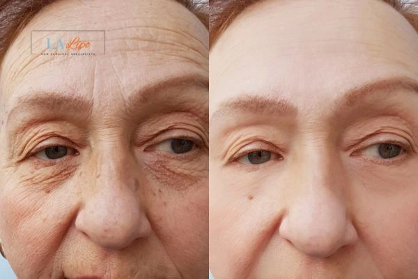 The powerful benefits of Morpheus8 Treatment Kingston Hill - Call Our team today!