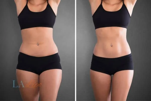 before and after results of non-surgical treatment to help a woman's body image and mental health Kingston Hill