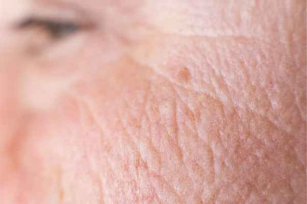 close up picture of a woman's face showing an age spot Kingston Hill