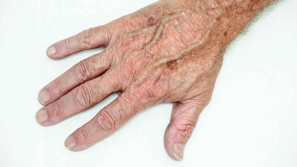 Male hand showing age spot Kingston Hill