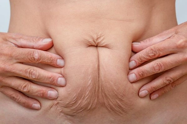Image of a woman's stomach with loose skin - example of skin tightening Kingston Hill options