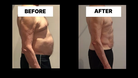 What Symptoms Can Diastasis Recti Cause in Men? Weak Core, Back Pain and Poor Posture Kingston Hill